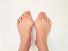 Qu'est qu'un Hallux Valgus?